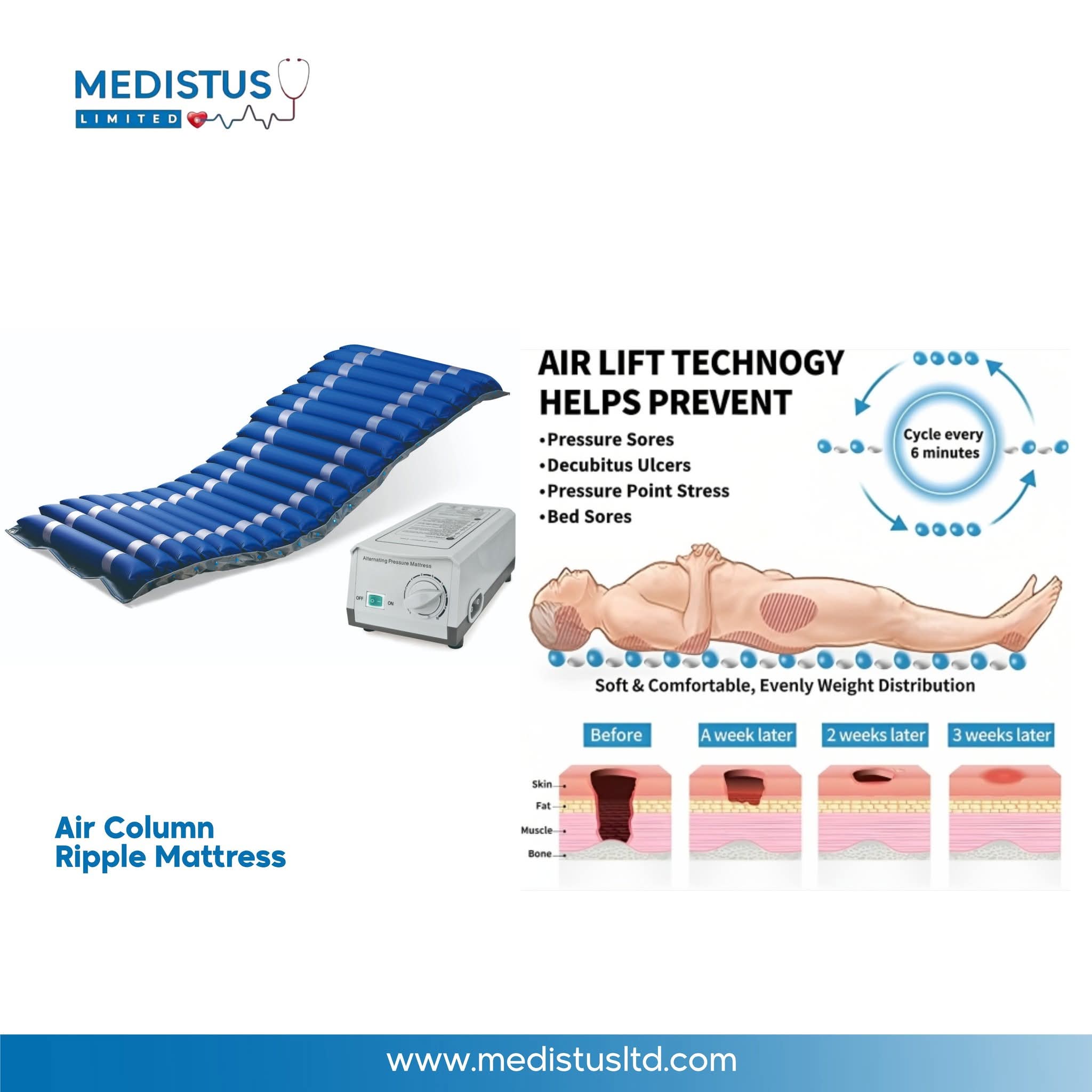 Medical Alternating Air Column Ripple Mattress (Anti-Bedsore System